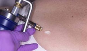 Liquid Nitrogen for Mole Removal