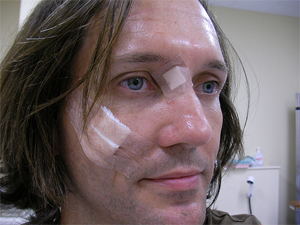 Mole Removal Cosmetic Surgery