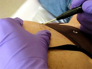 Mole Removal in England