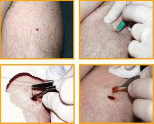 Mole Removal in Glasgow