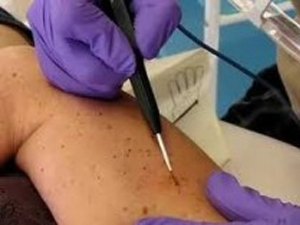 Radiosurgical Mole Removal