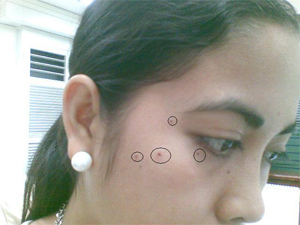 Wart and Mole Removal